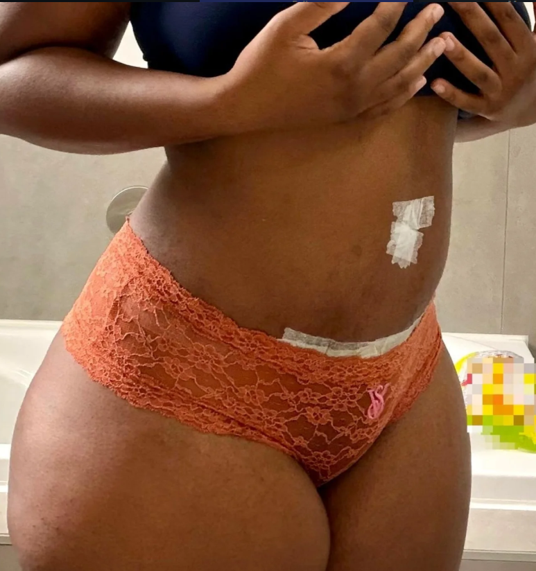 Abdominoplasty Case 1